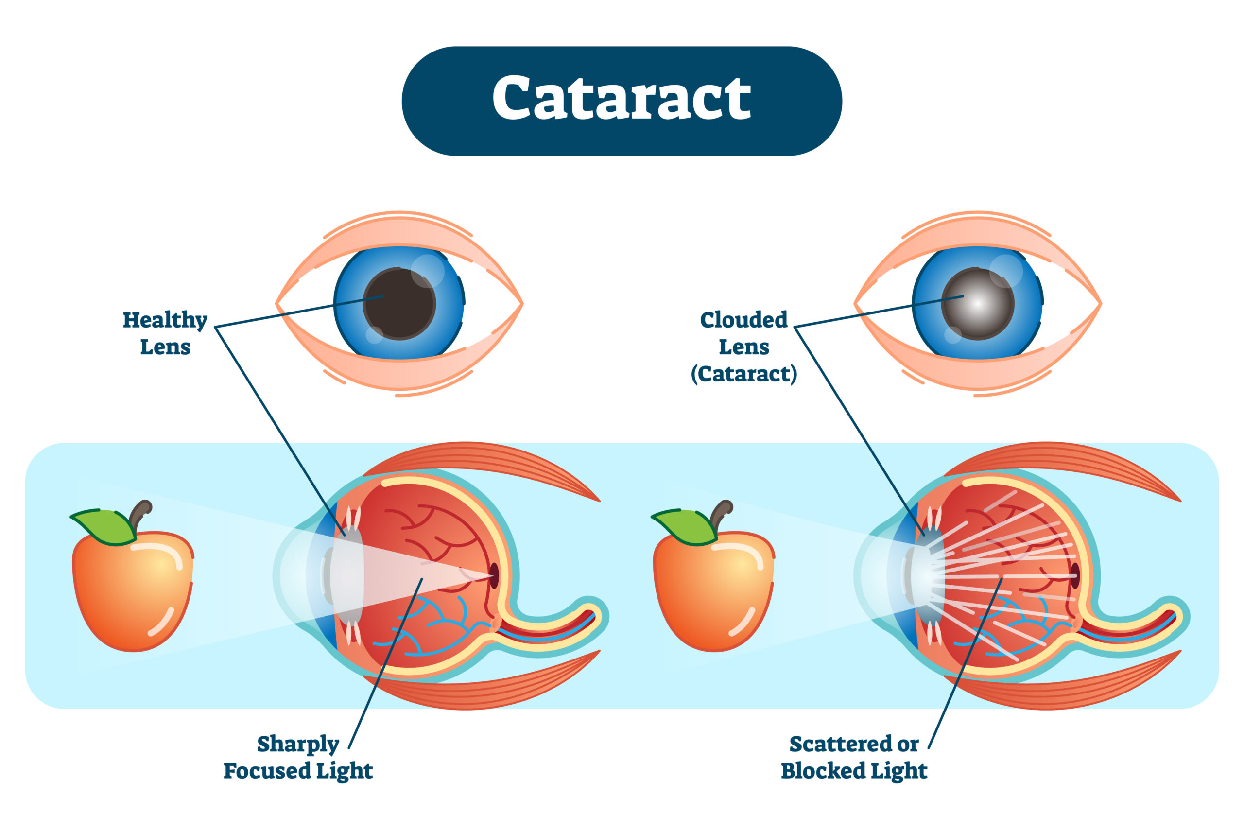 Cataract awareness month. The Eye Center